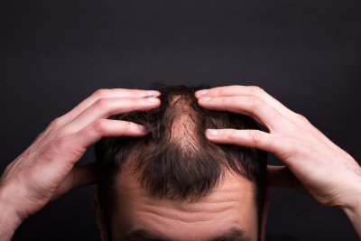 Dit zijn de mogelijkheden voor een haartransplantatie